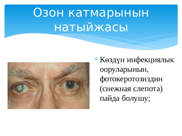 Озон катмарынын натыйжасы Көздүн инфекциялык ооруларынын, фотокеротозиздин (снежная слепота) пайда болушу;   