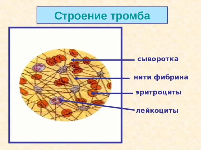 Строение тромба сыворотка нити фибрина эритроциты лейкоциты  