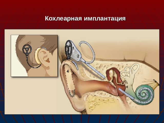 Кохлеарная имплантация 