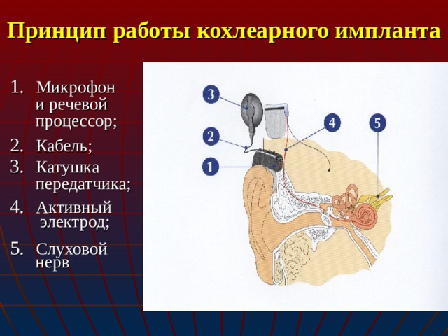 Принцип работы кохлеарного импланта Микрофон  и речевой  процессор; Кабель; Катушка  передатчика; Активный  электрод; Слуховой  нерв  