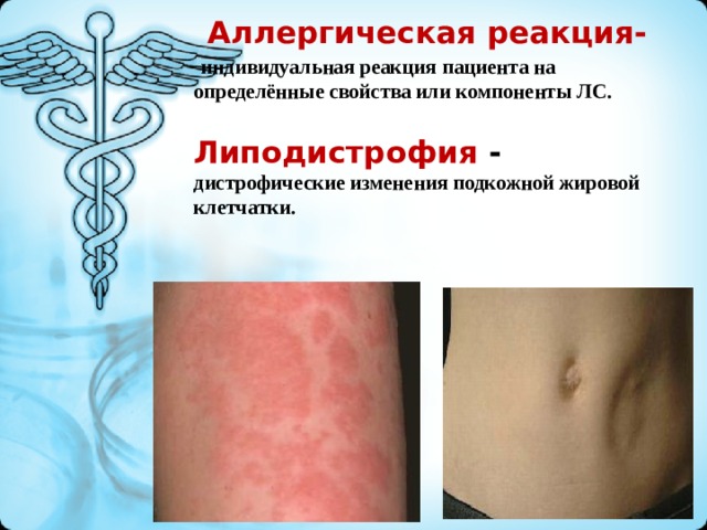 Аллергические реакции на коже фото и описание