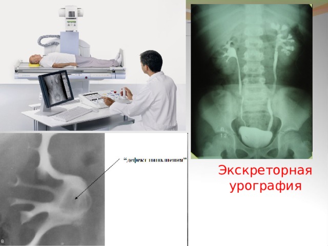 Внутривенная урография презентация