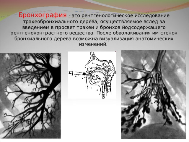 Усиление и обогащение сосудисто бронхиального рисунка