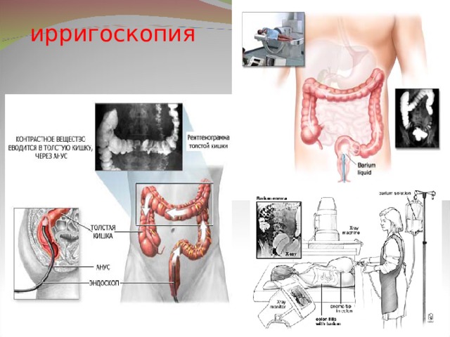 Процедура ирригоскопия кишечника. Рентгенологическое исследование толстой кишки (ирригоскопия). Ирригоскопия Толстого кишечника норма. Ирригоскопия сигмовидной кишки.