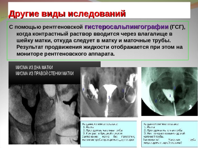 Методика гистеросальпингографии рисунок