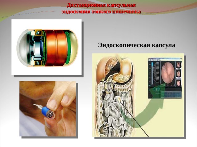 Капсульная эндоскопия презентация