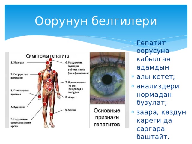 Оорунун белгилери Гепатит оорусуна кабылган адамдын алы кетет; анализдери нормадан бузулат; заара, көздүн кареги да саргара баштайт. 