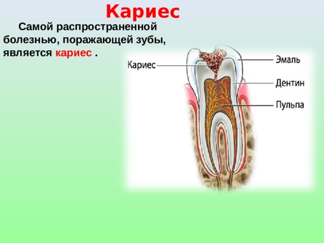 Кариес  Самой распространенной болезнью, поражающей зубы, является кариес .  