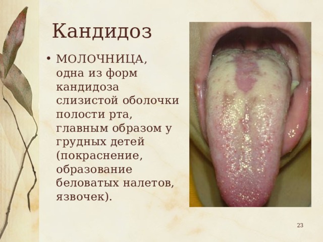 Кандидоз МОЛОЧНИЦА, одна из форм кандидоза слизистой оболочки полости рта, главным образом у грудных детей (покраснение, образование беловатых налетов, язвочек).  