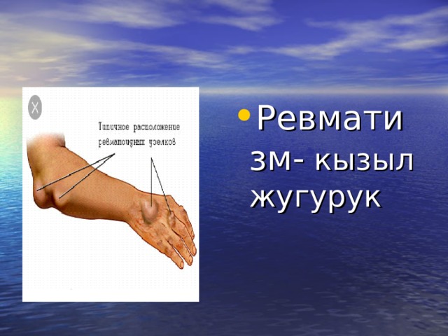 Ревматизм- кызыл жугурук 