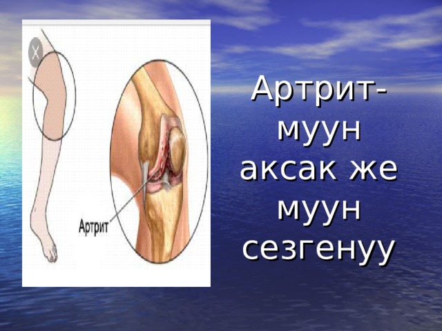 Артрит-муун аксак же муун сезгенуу 