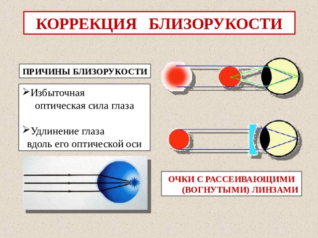 Оптическая сила глаза человека 58. Коррекция близорукости. Оптическая коррекция близорукости. Оптическая коррекция миопии. Линзы для коррекции близорукости.