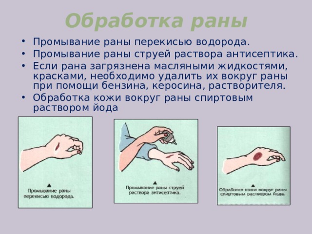 Обработка раны Промывание раны перекисью водорода. Промывание раны струей раствора антисептика. Если рана загрязнена масляными жидкостями, красками, необходимо удалить их вокруг раны при помощи бензина, керосина, растворителя. Обработка кожи вокруг раны спиртовым раствором йода 