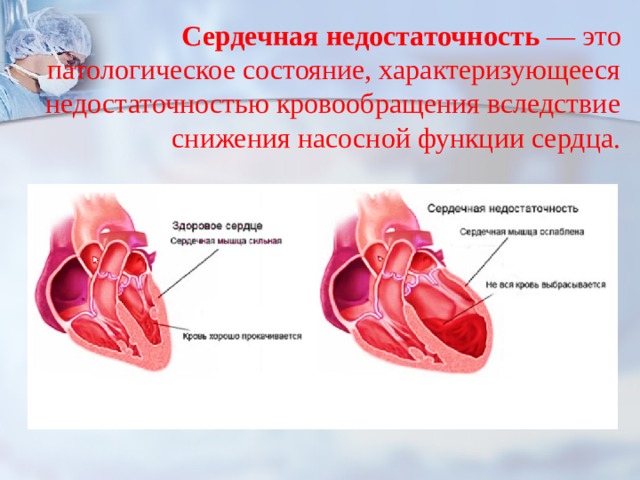 Острая сердечная недостаточность картинки