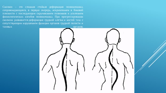 Презентация про сколиоз