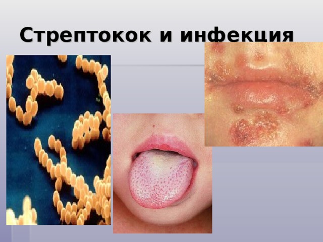 Стрептокок и инфекция 
