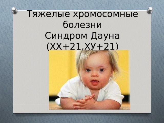 Тяжелые хромосомные болезни  Синдром Дауна (ХХ+21,ХУ+21) 