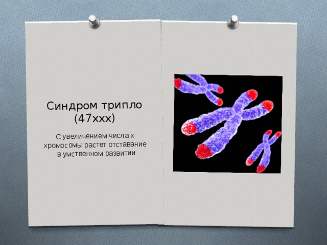 Синдром трипло (47ххх) С увеличением числа х хромосомы растет отставание в умственном развитии 