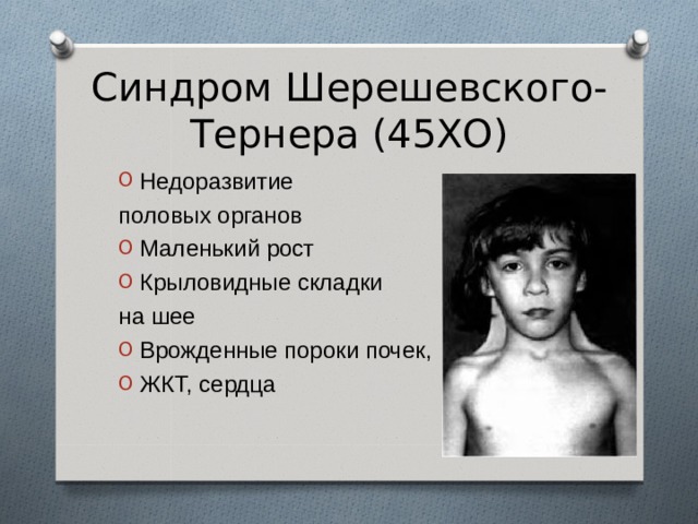 Синдром Шерешевского-Тернера (45ХО) Недоразвитие половых органов Маленький рост Крыловидные складки на шее Врожденные пороки почек, ЖКТ, сердца 