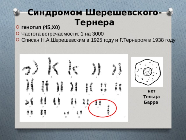 Синдром шерешевского тернера тельце барра. Генотип Шерешевского Тернера. Тельца Барра в кариотипе. Синдром Шерешевского Тернера тельца Барра.