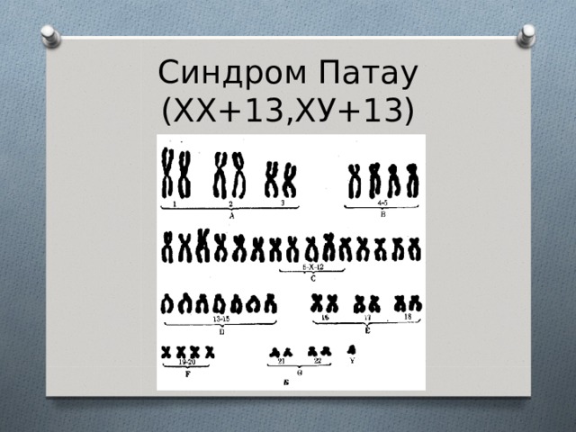Синдром Патау (ХХ+13,ХУ+13) 