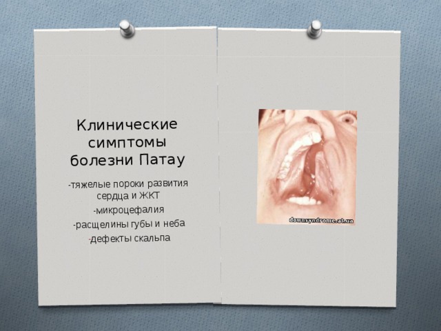 Клинические симптомы болезни Патау -тяжелые пороки развития сердца и ЖКТ -микроцефалия -расщелины губы и неба дефекты скальпа  
