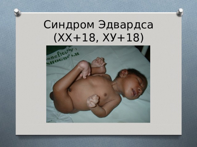Синдром Эдвардса (ХХ+18, ХУ+18) 