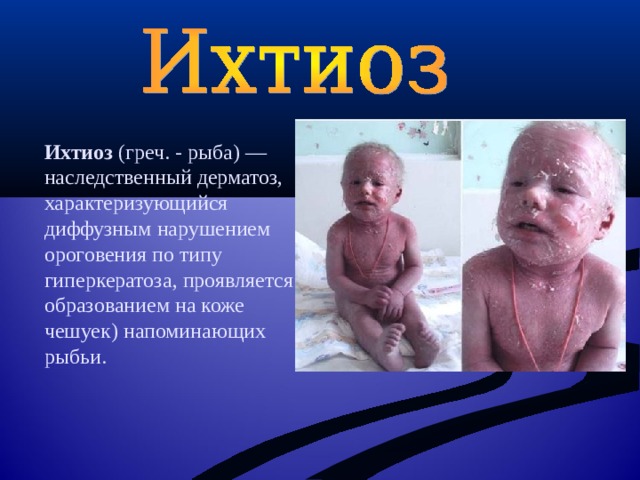 Ихтиоз (греч. - рыба) — наследственный дерматоз, характеризующийся диффузным нарушением ороговения по типу гиперкератоза, проявляется образованием на коже чешуек) напоминающих рыбьи. 