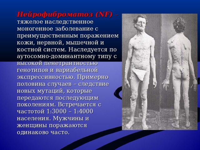 Нейрофиброматоз (NF) – тяжелое наследственное моногенное заболевание с преимущественным поражением кожи, нервной, мышечной и костной систем. Наследуется по аутосомно-доминантному типу с высокой пенетрантностью генотипов и вариабельной экспрессивностью. Примерно половина случаев – следствие новых мутаций, которые передаются последующим поколениям. Встречается с частотой 1:3000 – 1:4000 населения. Мужчины и женщины поражаются одинаково часто. 