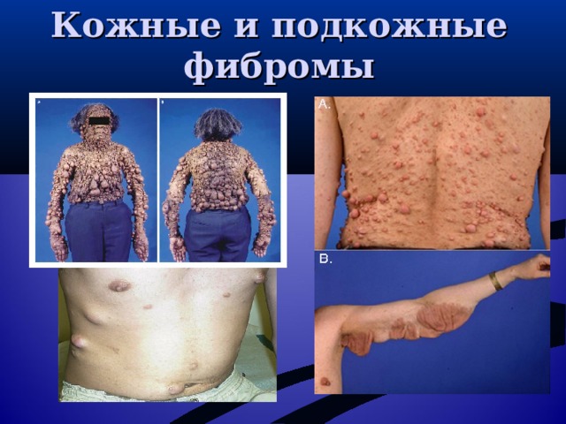   Кожные и подкожные фибромы 