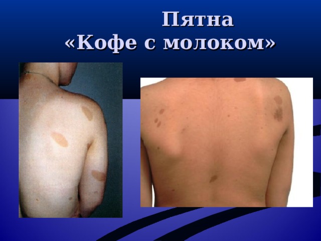  Пятна  «Кофе с молоком» 