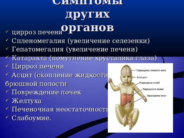 Симптомы других органов цирроз печени Спленомегалия (увеличение селезенки) Гепатомегалия (увеличение печени) Катаракта (помутнение хрусталика глаза) Цирроз печени Асцит (скопление жидкости в брюшной полости Повреждение почек Желтуха Печеночная неостаточность. Слабоумие. 