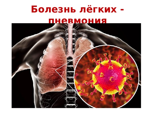 Болезнь лёгких - пневмония 