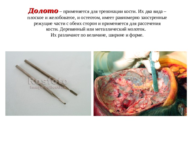 Долото  – применяется для трепонации кости. Их два вида –плоское и желобоватое, и остеотом, имеет равномерно заостренные режущие части с обеих сторон и применяется для рассечения кости. Деревянный или металлический молоток. Их различают по величине, ширине и форме. 