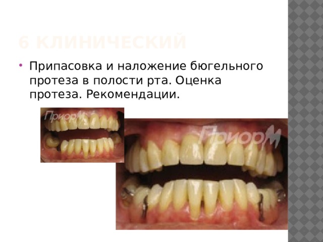 6 клинический Припасовка и наложение бюгельного протеза в полости рта. Оценка протеза. Рекомендации. 