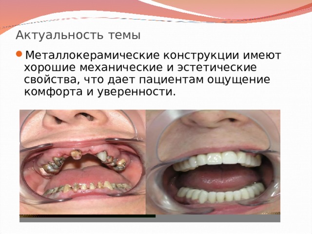 Актуальность темы Металлокерамические конструкции имеют хорошие механические и эстетические свойства, что дает пациентам ощущение комфорта и уверенности. 