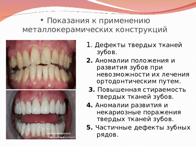  Показания к применению металлокерамических конструкций 1 . Дефекты твердых тканей зубов. 2. Аномалии положения и развития зубов при невозможности их лечения ортодонтическим путем.  3. Повышенная стираемость твердых тканей зубов. 4. Аномалии развития и некариозные поражения твердых тканей зубов. 5. Частичные дефекты зубных рядов. 