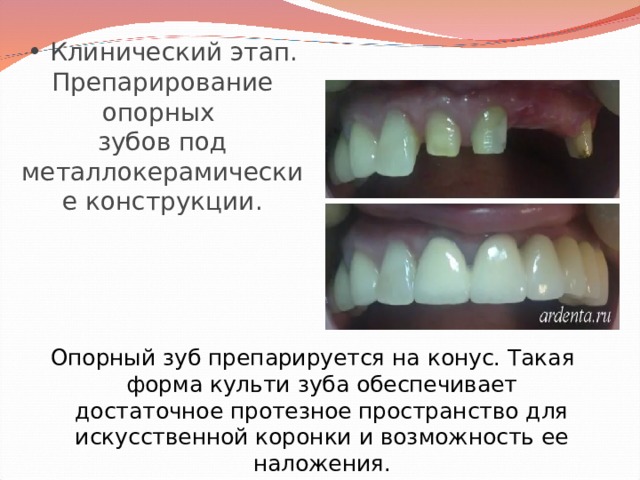  Клинический этап.  Препарирование опорных  зубов под металлокерамические конструкции. Опорный зуб препарируется на конус. Такая форма культи зуба обеспечивает достаточное протезное пространство для искусственной коронки и возможность ее наложения. 
