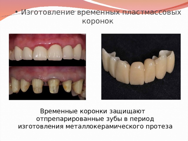  Изготовление временных пластмассовых коронок Временные коронки защищают отпрепарированные зубы в период изготовления металлокерамического протеза 