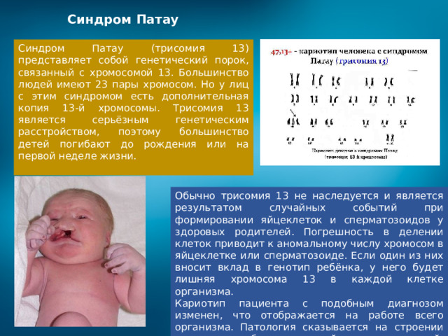 Синдром Патау Синдром Патау (трисомия 13) представляет собой генетический порок, связанный с хромосомой 13. Большинство людей имеют 23 пары хромосом. Но у лиц с этим синдромом есть дополнительная копия 13-й хромосомы. Трисомия 13 является серьёзным генетическим расстройством, поэтому большинство детей погибают до рождения или на первой неделе жизни. Обычно трисомия 13 не наследуется и является результатом случайных событий при формировании яйцеклеток и сперматозоидов у здоровых родителей. Погрешность в делении клеток приводит к аномальному числу хромосом в яйцеклетке или сперматозоиде. Если один из них вносит вклад в генотип ребёнка, у него будет лишняя хромосома 13 в каждой клетке организма. Кариотип пациента с подобным диагнозом изменен, что отображается на работе всего организма. Патология сказывается на строении скелета, работе нервной, выделительной, репродуктивной и сердечно-сосудистой систем. 