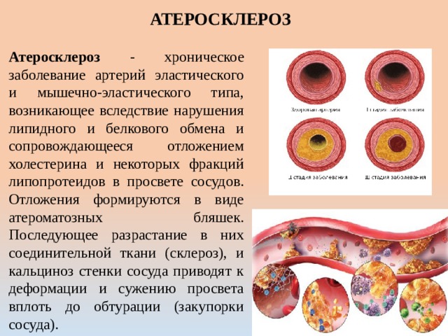 Атеросклероз картинки для презентации