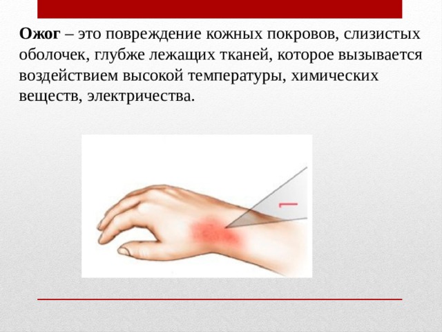Ожог – это повреждение кожных покровов, слизистых оболочек, глубже лежащих тканей, которое вызывается воздействием высокой температуры, химических веществ, электричества. 