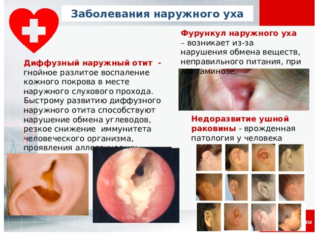 Заболевания наружного уха Фурункул наружного уха – возникает из-за нарушения обмена веществ, неправильного питания, при авитаминозе.   Диффузный наружный отит - гнойное разлитое воспаление кожного покрова в месте наружного слухового прохода. Быстрому развитию диффузного наружного отита способствуют нарушение обмена углеводов, резкое снижение иммунитета человеческого организма, проявления аллергических реакций. Недоразвитие ушной раковины - врожденная патология у человека 
