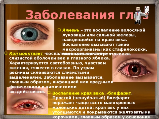 Заболевания глаз Ячмень – это воспаление волосяной луковицы или сальной железы, находящейся на краю века. Воспаление вызывают такие микроорганизмы как стафилококки, пневмококки и стрептококки. Конъюнктивит -воспаление конъюнктивы-слизистой оболочки век и глазного яблока. Характеризуется светобоязнью, чувством жжения, тяжести в глазах. По утрам ресницы склеиваются слизистыми выделениями. Заболевание вызывается, главным образом, инфекцией или вредными физическими и химическими воздействиями. Воспаление края века -блефарит . Простой (чешуйчатый) блефарит поражает чаще всего малокровных маленьких детей: края век у них утолщаются и покрываются желтоватыми корочками, главным образом у основания ресниц. 