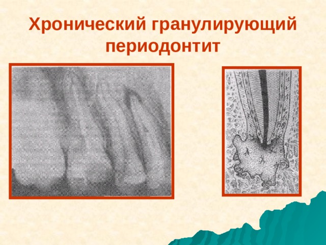 Хронический фиброзный периодонтит мкб. Периодонтит фиброзный гранулематозный гранулирующий. Периодонтит классификация гранулематозный. Острый гранулирующий периодонтит. Гранулирующий периодонтит гистология.