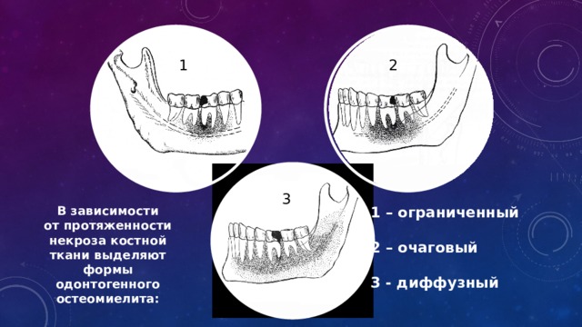 Как выглядит остеомиелит зубов Одонтогенный остеомиелит челюсти