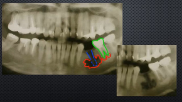 Периостит верхней челюсти фото Одонтогенный остеомиелит челюсти