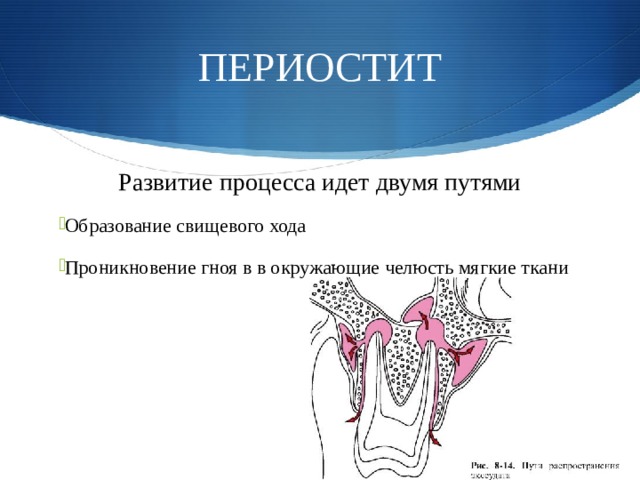 Периостит этиология