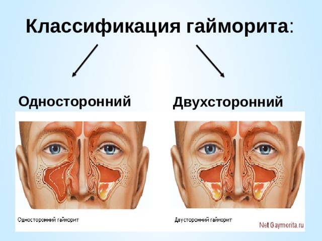 Гайморит: заразен ли