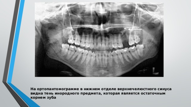 На ортопантомограмме в нижнем отделе верхнечелюстного синуса видна тень инородного предмета, которая является остаточным корнем зуба 